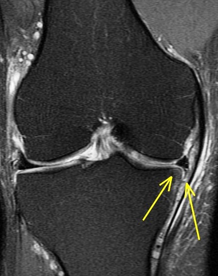 Figure 5 for case Unstable displaced medial meniscus tear( RID2772 ) with reactive tibial edema